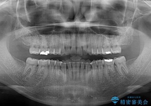 受け口傾向の前歯 すきっ歯の改善の治療後
