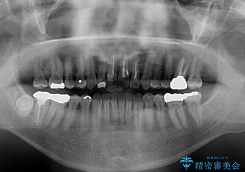 上顎の狭窄歯列 インビザラインによる拡大矯正の治療後