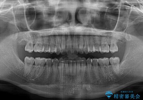 上下前歯の叢生をインビザラインできれいにの治療後