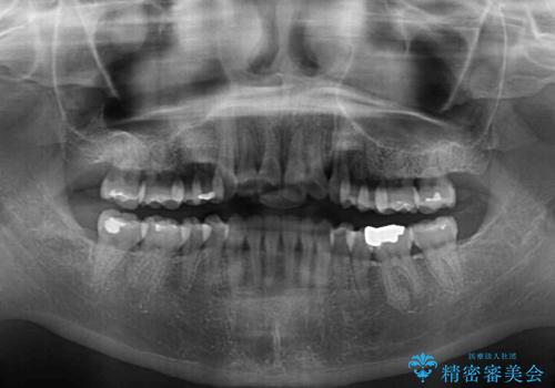 口元の突出感を改善 インビザラインによる非抜歯矯正の治療後