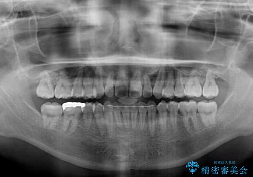 インビザラインが続けられない ワイヤー装置での矯正治療の治療後
