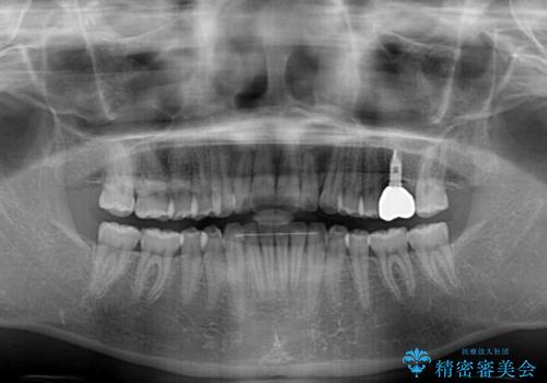 インプラントによる補綴治療とインビザライン矯正の治療後