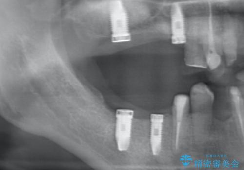 インプラント治療で達成するしっかりと食事できる噛み合わせの治療中