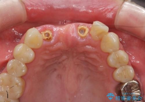 前歯が折れた 前歯部審美セラミックブリッジ治療の治療前