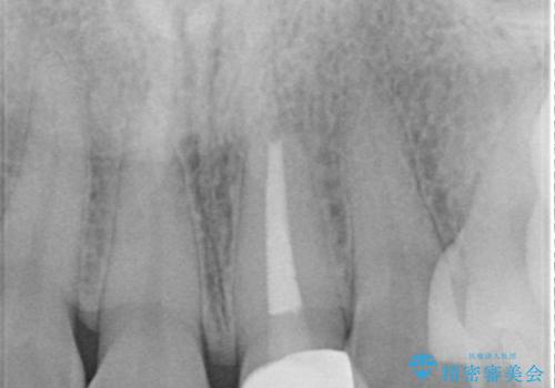 前歯を綺麗にしたい オールセラミッククラウンの治療後