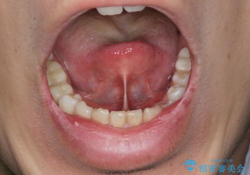 [舌小帯形成術]  滑舌が悪いと言われるの治療前