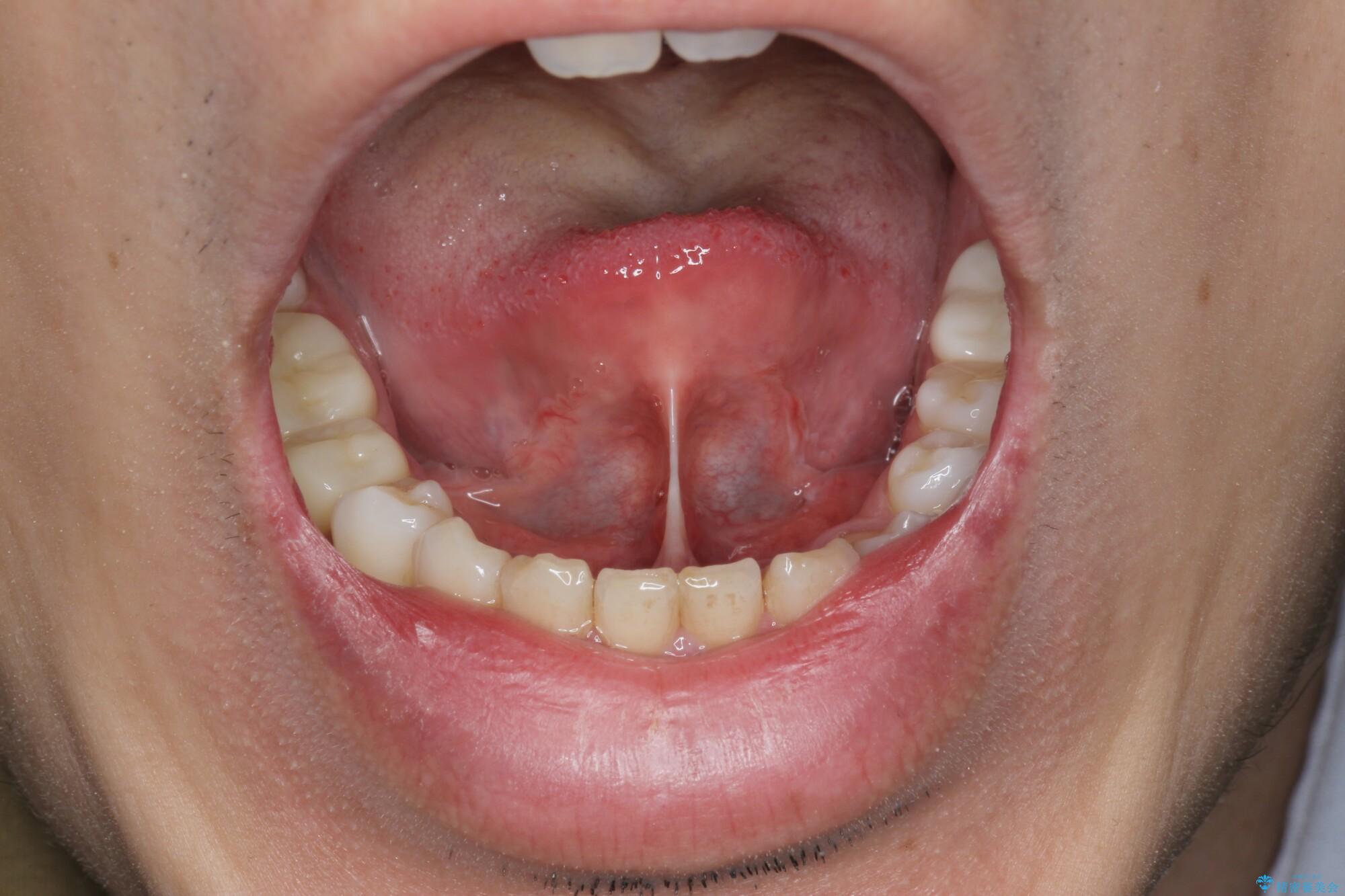 张利兵：“观舌象辨健康”第19讲--舌形辨证诊病之芒刺舌 - 知乎