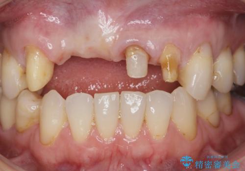 前歯が折れた 前歯部審美セラミックブリッジ治療の治療中