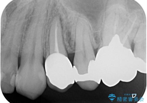 大きい虫歯 根管治療〜オールセラミッククラウンの治療後