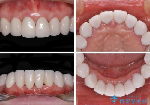出っ歯を改善した後に真っ白な歯に　矯正歯科治療と審美歯科治療の治療後