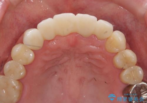 前歯が折れた 前歯部審美セラミックブリッジ治療の治療後