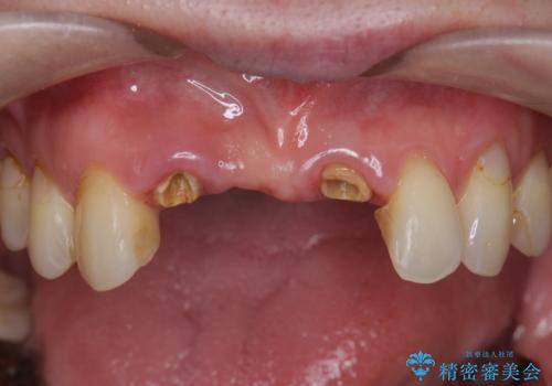 前歯が折れた 前歯部審美セラミックブリッジ治療の症例 治療前