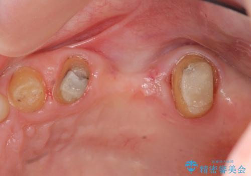 歯周病 ブリッジ補綴の治療中
