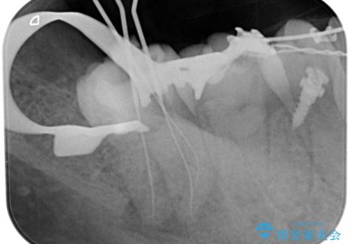 奥の歯茎にニキビみたいなものができた!の治療前