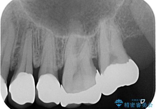 縁下カリエス オールセラミッククラウンの治療後