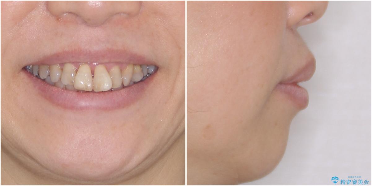 出っ歯を改善した後に真っ白な歯に　矯正歯科治療と審美歯科治療の治療前（顔貌）