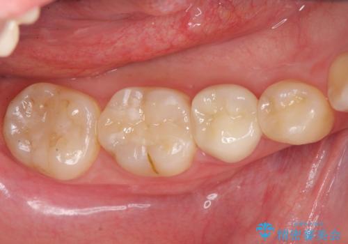 コンポジットレジン修復下で再発する虫歯の治療後
