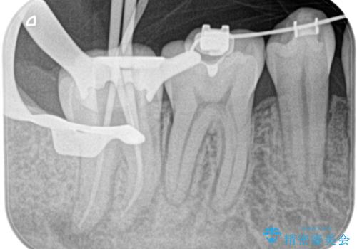 奥の歯茎にニキビみたいなものができた!の治療中