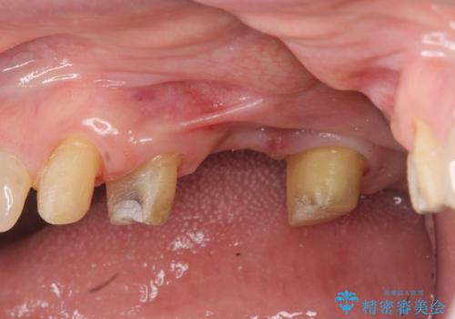 歯周病 ブリッジ補綴の治療中