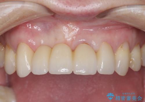 前歯が折れた 前歯部審美セラミックブリッジ治療の症例 治療後