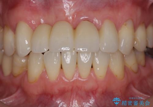 前歯が折れた 前歯部審美セラミックブリッジ治療の治療後