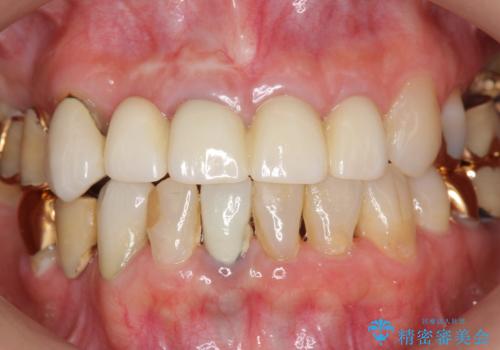 状況に応じた前歯の補綴計画の治療後