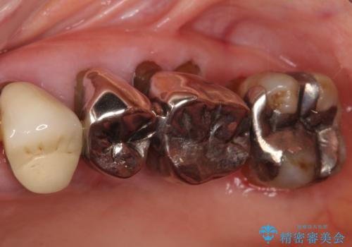 歯ぐきから血が出る、歯ぐきが腫れている 80代女性の治療前