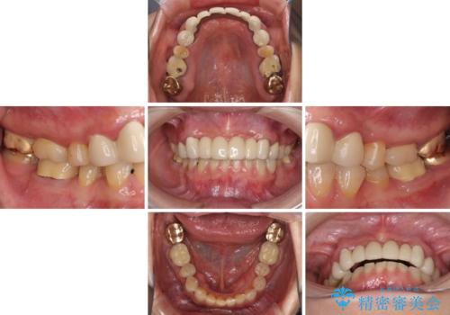出血が止まらない インプラント補綴を用いた歯周病治療の治療前