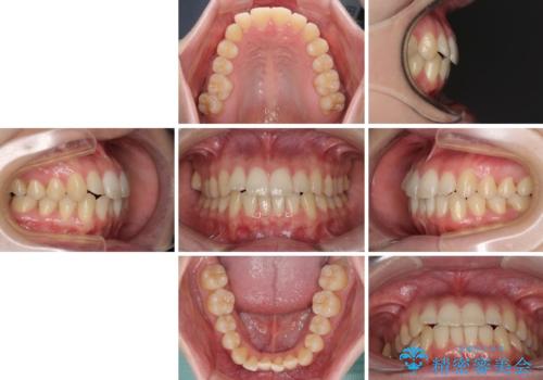 気になる前歯を整えたい インビザライン・ライトでの矯正治療の治療前