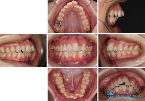 スッキリとした口元へ 出っ歯の抜歯矯正の治療前