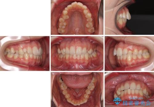 狭い上顎骨を拡大 急速拡大装置を併用したインビザライン矯正の治療前