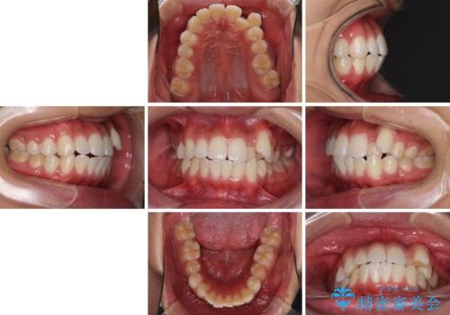 八重歯と奥歯のクロスバイト 上顎骨を拡大してインビザラインで矯正の治療前