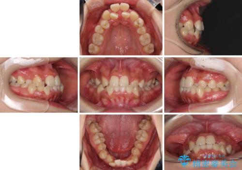 前後に重なった前歯 ワイヤー装置と急速拡大装置を併用したインビザライン矯正の治療前