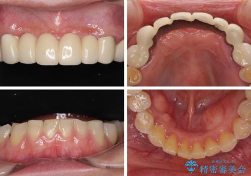 出血が止まらない インプラント補綴を用いた歯周病治療の治療前
