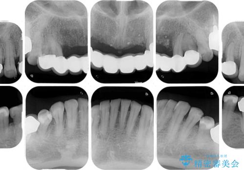 出血が止まらない インプラント補綴を用いた歯周病治療の治療前