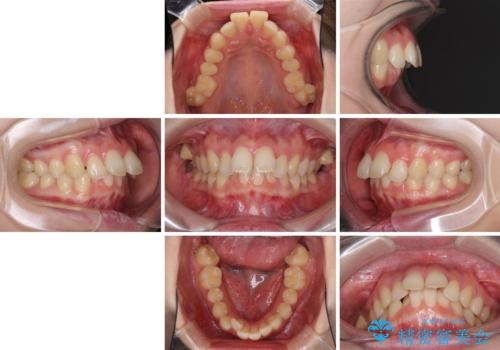費用を抑えた抜歯矯正　口元の突出感の改善の治療前
