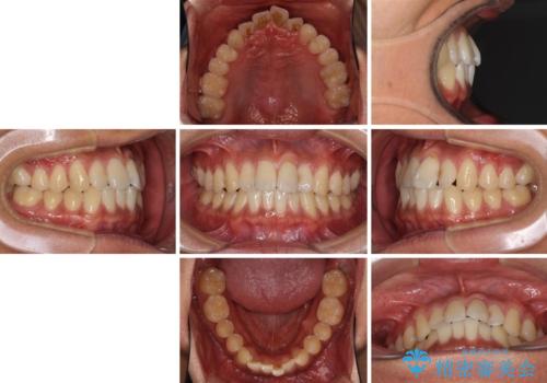 気になる前歯のデコボコをインビザラインで解消の治療前