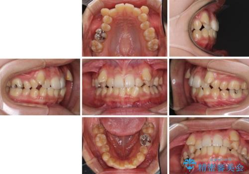 八重歯の抜歯矯正 補助装置を用いたインビザライン矯正の治療前