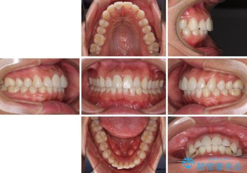 口が閉じにくい インビザラインによる矯正治療の治療前