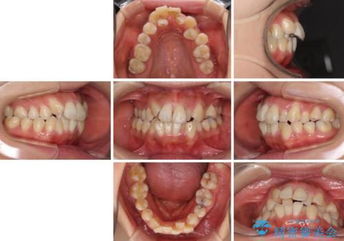 狭い上顎骨を拡大 著しい叢生を抜歯矯正で改善の治療前
