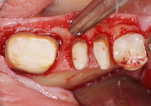 歯ぐきから血が出る、歯ぐきが腫れている 80代女性の治療中