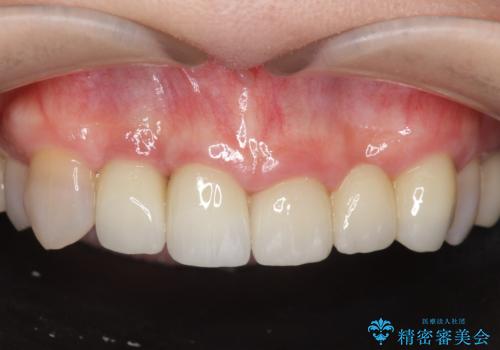 [歯ぐきの腫れを改善]  不適合なセラミッククラウンの症例 治療後