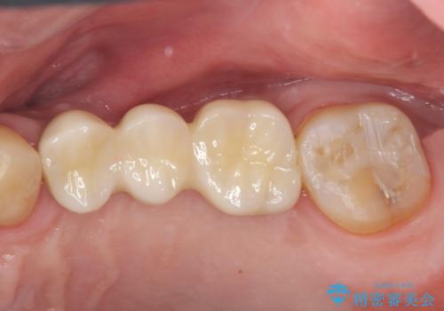 咬合平面を揃え、早期接触・干渉を防ぐ補綴治療の治療後