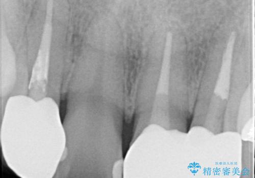歯並びを含めて前歯をきれいにしたい インビザラインとセラミック治療の治療後