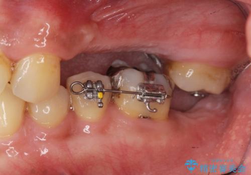 咬合平面を揃え、早期接触・干渉を防ぐ補綴治療の治療中