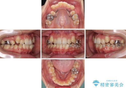 八重歯の抜歯矯正 補助装置を用いたインビザライン矯正の治療中