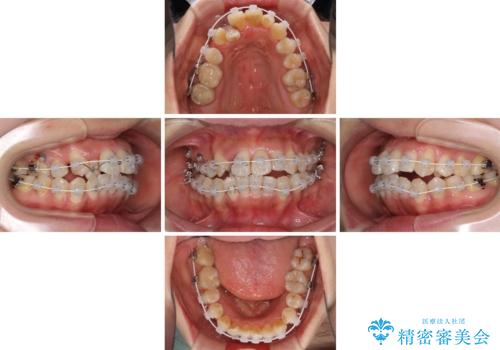 狭い上顎骨を拡大 著しい叢生を抜歯矯正で改善の治療中