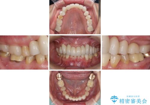 出血が止まらない インプラント補綴を用いた歯周病治療の治療後