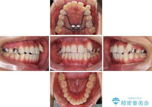 八重歯と奥歯のクロスバイト 上顎骨を拡大してインビザラインで矯正の治療中