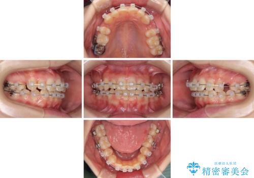 前歯2本が欠損　抜歯矯正でデコボコを治すの治療中
